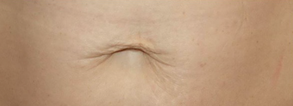 HALO laser before and after — texture improvement
