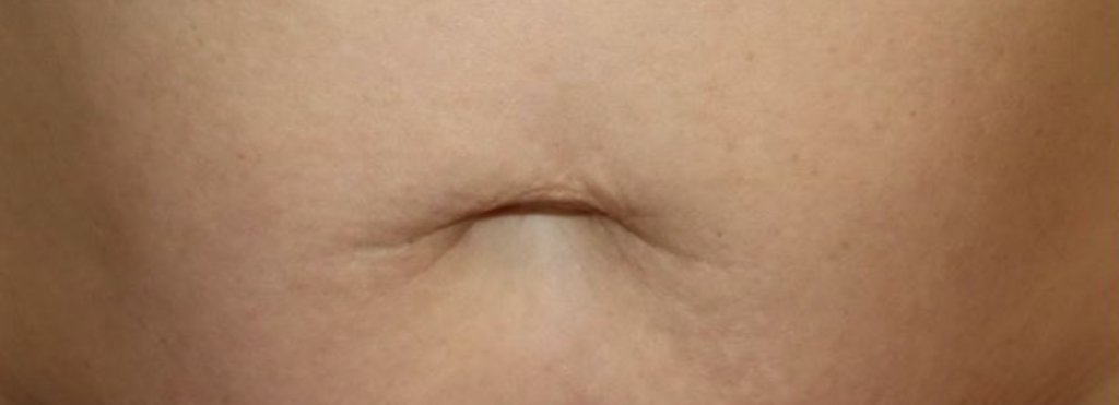 HALO laser before and after — tone correction